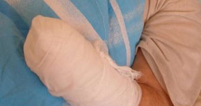В Стаханове мужчине оторвало пальцы взрывом предмета, найденного на улице