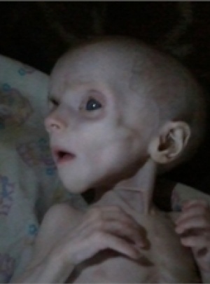 В Донецке умерла полугодовалая девочка, изнуренная голодом